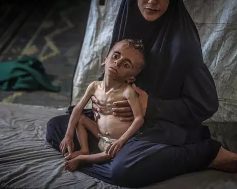 Severe malnutrition in under-5s has tripled at Gaza City clinic Severe malnutrition in under-5s has tripled at Gaza City clinic