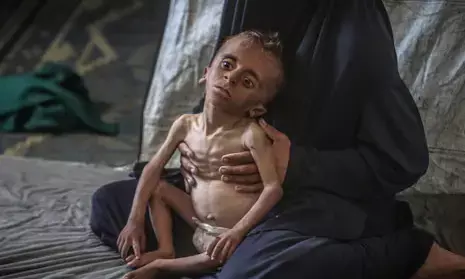 Severe malnutrition in under-5s has tripled at Gaza City clinic Severe malnutrition in under-5s has tripled at Gaza City clinic